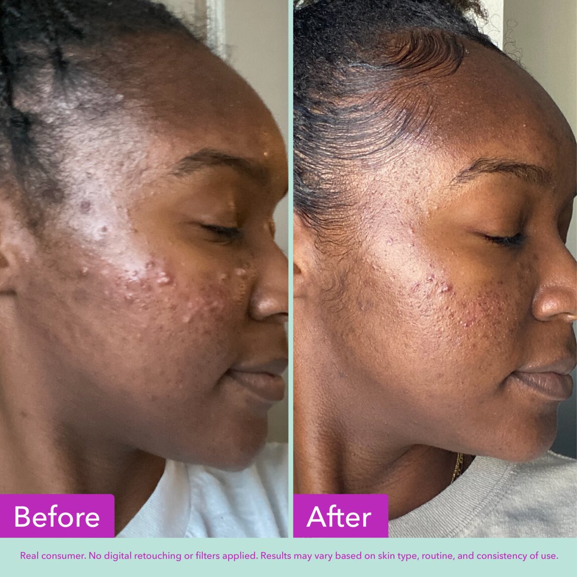 acne-foaming-cleanser-o6 zb_p.jpg